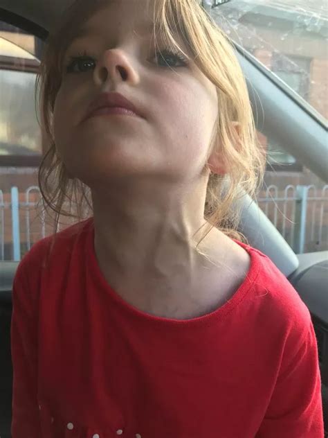 Girl Rushed To Hospital After Veins Bulge Out Of Neck Liverpool Echo