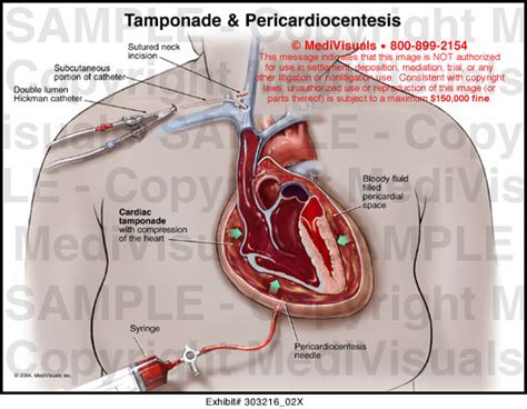 Medivisuals Tamponade And Pericardiocentesis Medical Illustration