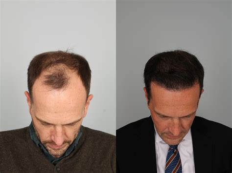 Neograft Hair Transplant Before And After Photo Gallery Louisville Ky Calospa® Rejuvenation