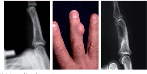 Figure 5 From Epidermoid Cysts In The Hand Semantic Scholar