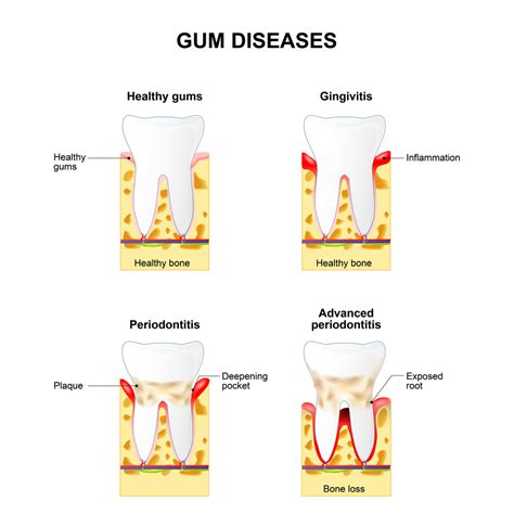 What Is Periodontitis Durham Nc Learn About Gum Disease 27707 3771