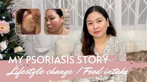 Eng My Psoriasis Story How I Manage My Flare Ups Psoriasis Diet