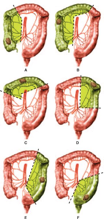 11 Chapter 14 Short Answer Colon Resections Pp 317 Diagram Quizlet