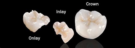 Inlays And Onlays Dms Dentistry