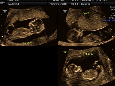 Pregnant With Triplets At 17 Weeks Its Time For The Big Gender