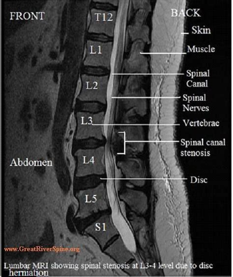 Lumbar Spine MRI Lumbar Spinal Stenosis Mri Health Lumbar Spinal
