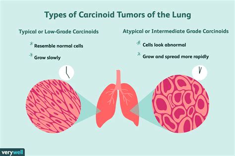 Neuroendocrine Lung Tumors Types Symptoms And More
