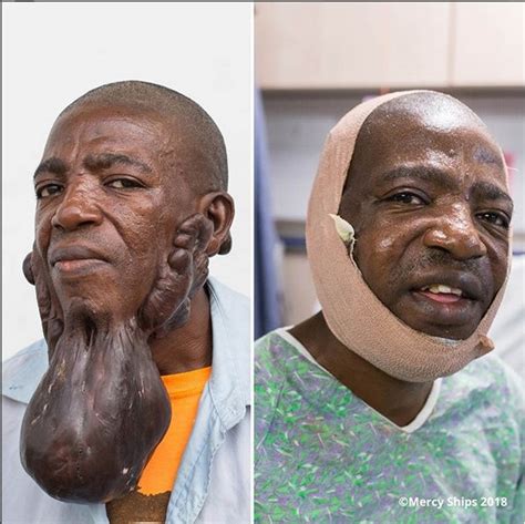 Man All Smiles After Removal Of Huge Tumor On His Face
