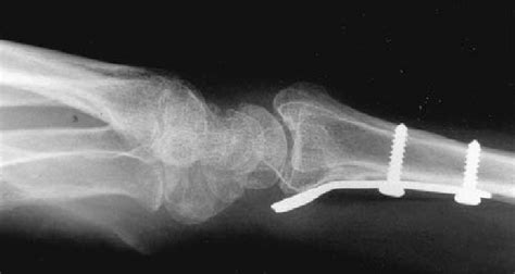 Case 4 Lateral Radiograph Of The Wrist Showing Prominence