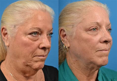 Patient 122406477 Laser Assisted Weekend Neck Lift Before And After