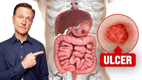The Fastest Way To Heal An Ulcer Youtube
