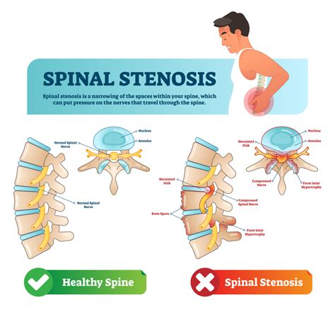 Spinal Stenosis And How It’s Treated Central Orthopedic Group