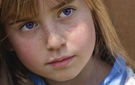 Purple Eye Disease Symptoms And Causes
