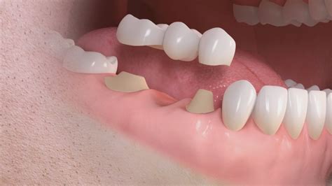 Implantes o puentes dentales qué es mejor para mí Clínica Dental
