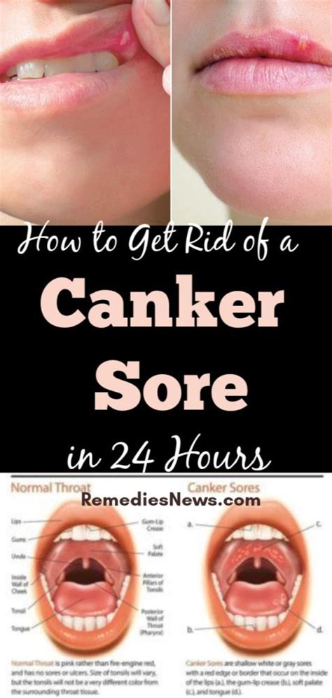 How To Get Rid Of A Canker Sore In 24 Hours 11 Best Canker Sore Treatments