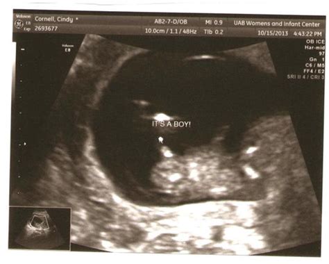 Is a nuchal translucency ultrasound recommended? anyone see pretty clearly boy/girl at 14 week ultrasound ...