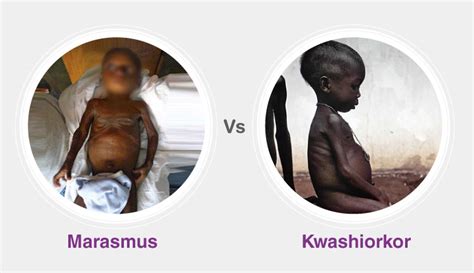 10 Interesting Difference Between Kwashiorkor And Marasmus With Table