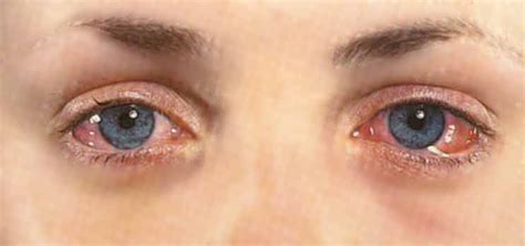 Conjunctivitis Insight Eye Specialists Utah Eye Doctors Insight