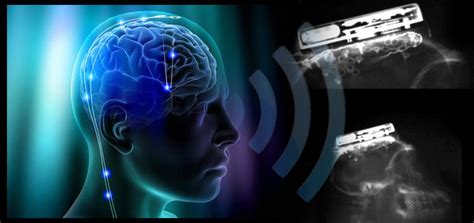 University Creates First Wireless Implanted Brain Computer Interface
