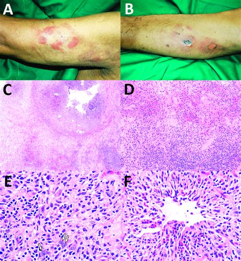 Granulomatous Dermatitis Pattern A Erythematous Plaques On Right