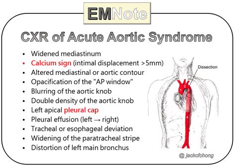 Causes Of Aortic Dissection