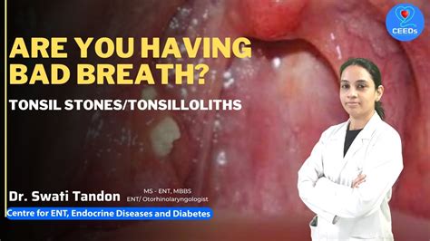 Are You Having Bad Breath Tonsil Stonestonsilloliths Dr Swati