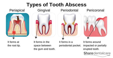 Dental Abscess Types Periapical Gingival Periodontal And Pericoronal