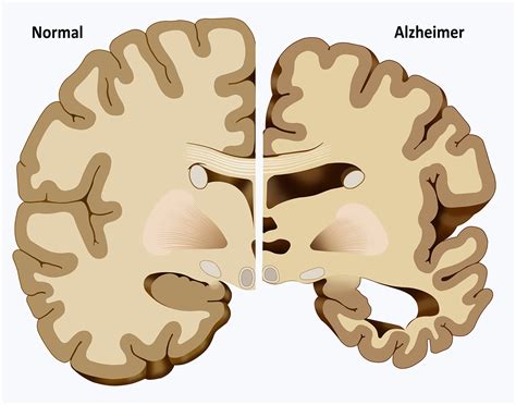Neurons affected develop surrounding amyloid plaques, neurofibrillary tangles, and produce less acetylcholine. De 5 belangrijkste voordelen van cannabis voor Alzheimer