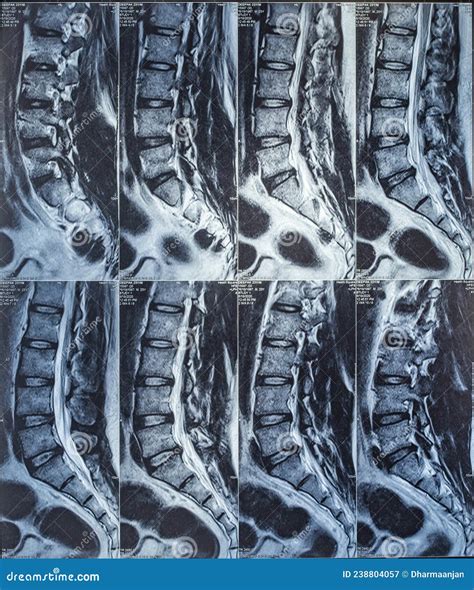 Ct Scan Of Lumbar Spine Case Of Lumbar Spondylosis Royalty Free Stock