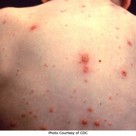 Chickenpox Symptoms And Pictures