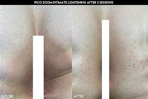 Anal Bleaching Before And After Telegraph