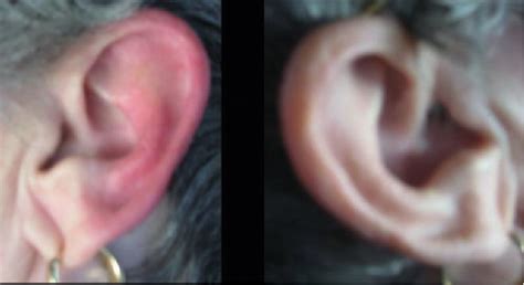 Figure 1 From Primary And Secondary Red Ear Syndrome Implications For