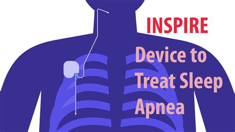 Inspire Device For Sleep Apnea Everything You Need To Know