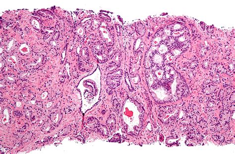 Fileprostate Cancer With Gleason Pattern 4 Low Mag Wikipedia