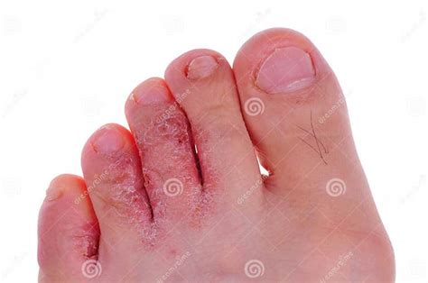 Athlete S Foot Fungus Stock Photo Image Of Foot Aged 11071934