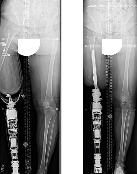 Osseointegration Limb Replacement More Control For Amputees