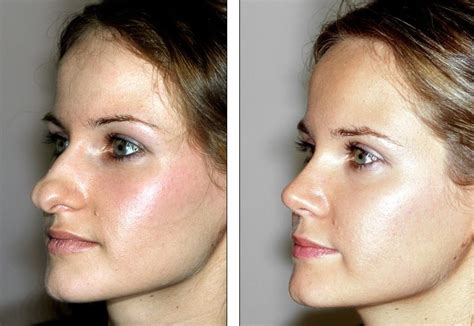 Rhinoplasty Nose Surgery Fullerton Ca Before After Photo My XXX Hot Girl