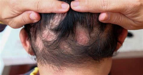 Alopecia areata conheça a causa e tratamento da condição