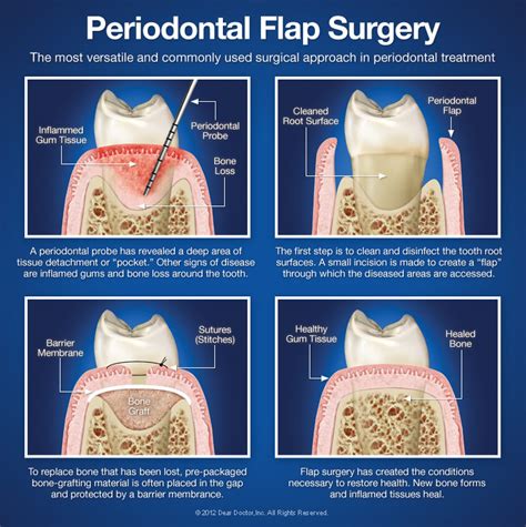 Periodontal Flap Surgery | The Flap Surgery Procedure