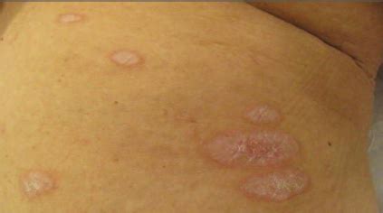 Lichen Sclerosus | Consultant360