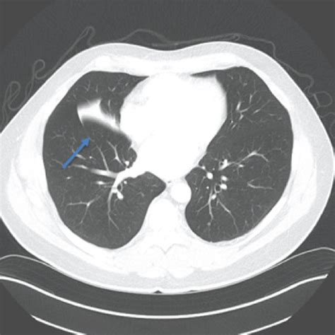 Poster Anterior And Lateral Chest X Ray Right Middle Lobe Infiltrate