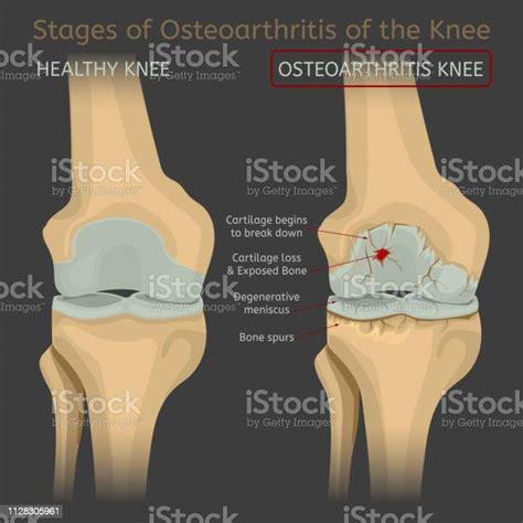 Stages Of Osteoarthritis Of The Knee Stock Illustration Download