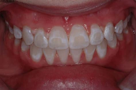 They can occur anywhere on the body where hair grows, including there are several possible causes of white spots on the testicles. Comprehensive Information on White Spots On Teeth ...