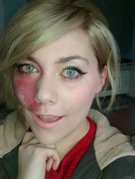 Woman With Facial Birthmark Was Told She Was Too Ugly For