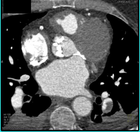 Aortic Valve Calcification With Aortic Stenosis As Well As Pulmonary