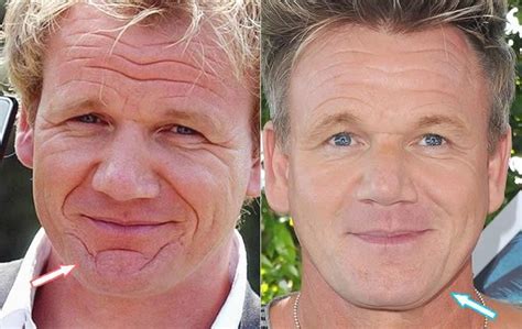 Gordon Ramsey S Plastic Surgery Before And After Vanity