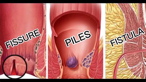 Difference Between Piles Fissure And Fistula