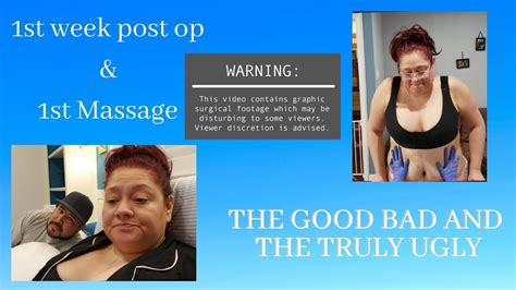 1st Week Post Op And 1st Massage Plasticsurgeryrecovery 1weekpostop 1stlympaticmassage Youtube