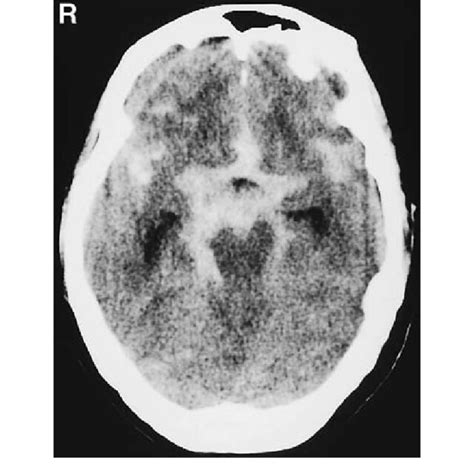 Brain Computed Tomography Scan Showing Diffuse Subarachnoid Hemorrhage