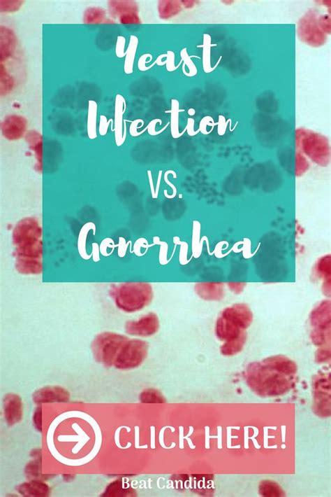 In that case, you're likely familiar with these. Is it Gonorrhea or Yeast Infection? - Beat Candida